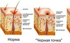 How to get rid of blackheads on face at home?