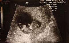 गर्भावस्था का ग्यारहवाँ सप्ताह - बच्चे का क्या होता है, भ्रूण की तस्वीर, संवेदनाएँ