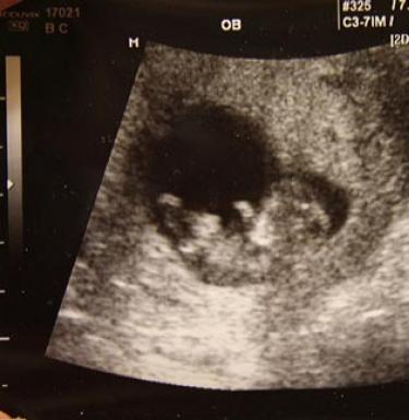 Enajsti teden nosečnosti - kaj se zgodi z otrokom, fotografija ploda, občutki