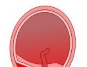 Regionálna placenta previa