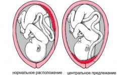 Types de localisation du placenta : le long des parois antérieure, postérieure et latérale de l'utérus, danger de placentation basse