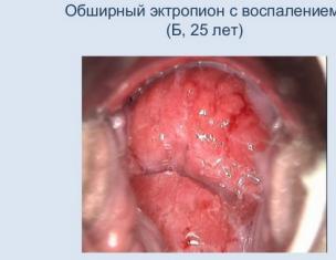 Fotografija prolapsa maternice Obrnjen maternični vrat po porodu